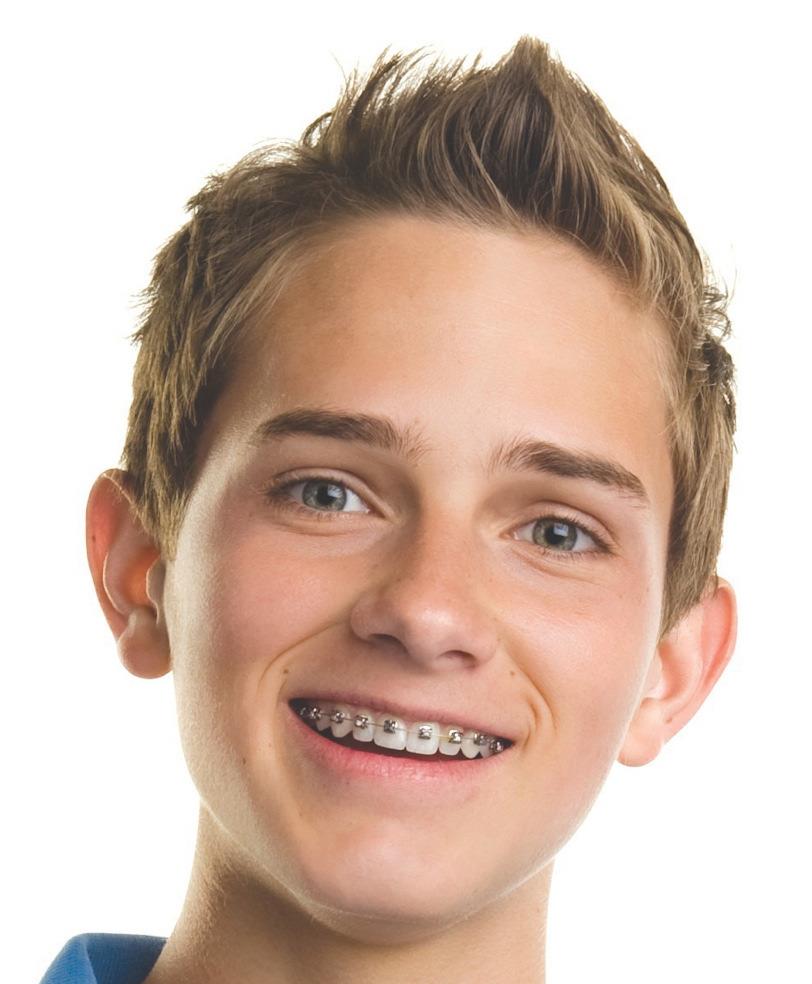 photo de traitement orthodontique classique pour chirurgie orthognatique