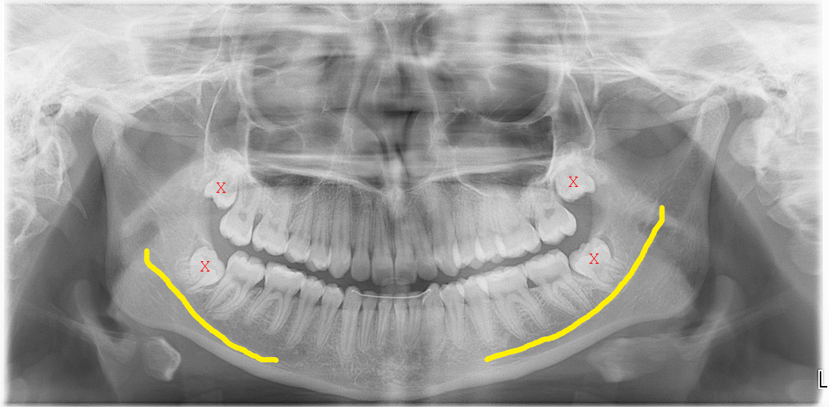 panoramique dentaire montrant les dents de sagesse et les nerfs alvéolaires inférieurs