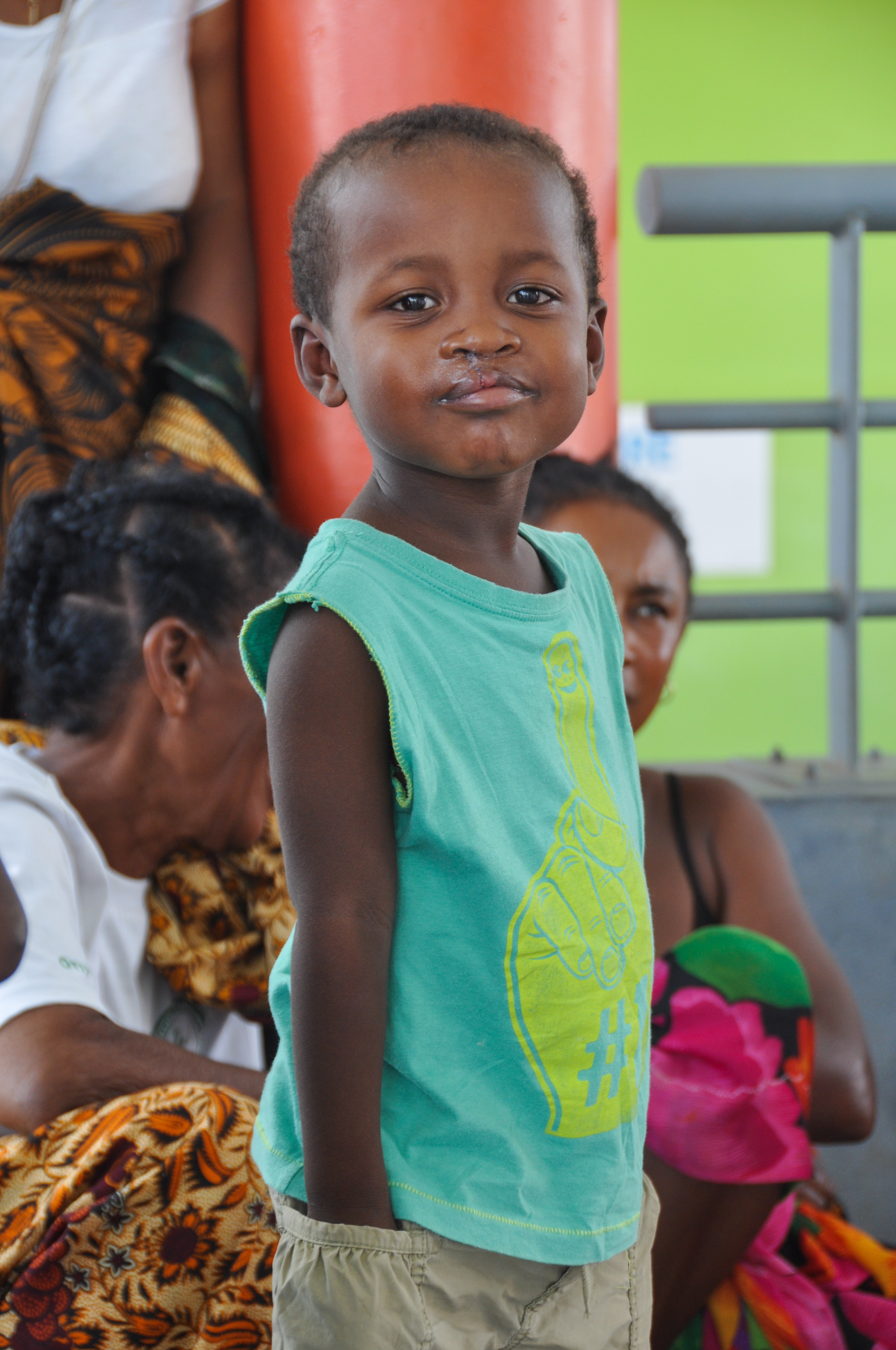 photo prise en mission humanitaire après correction d'une fente labiale