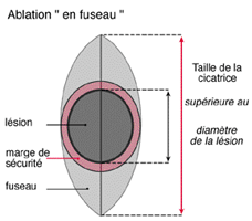 schéma d'une exérèse en fuseau et des marges de sécurité