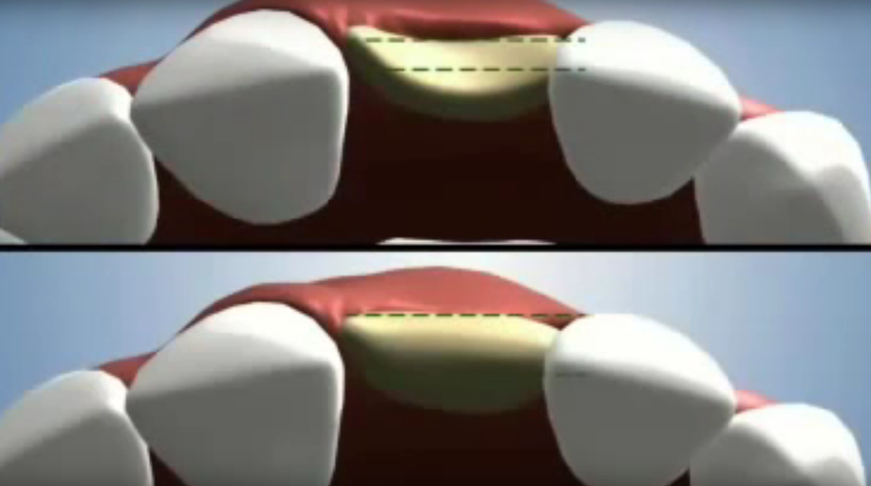 photo avant et après une greffe osseuse dentaire