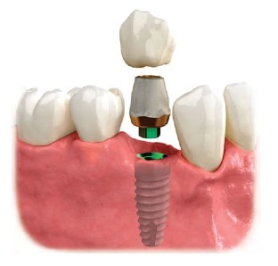 photo d'un implant dentaire avec le pilier et la couronne