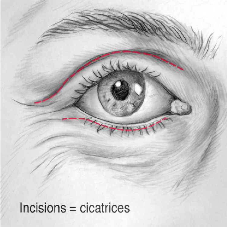 schéma des incisions pour une blépharoplastie