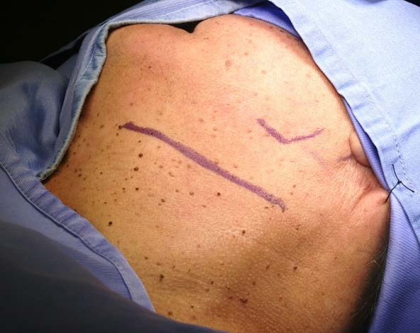 photo de l'incision pour l'ablation de la glande sous-maxillaire dans le cas d'une volumineuse lithiase salivaire