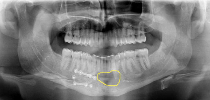 panoramique dentaire avec un kyste dentaire nécessitant une résection apicale
