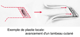 schéma d'un lambeau d'avancement