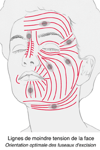 schéma des lignes de moindre de tension de Langer