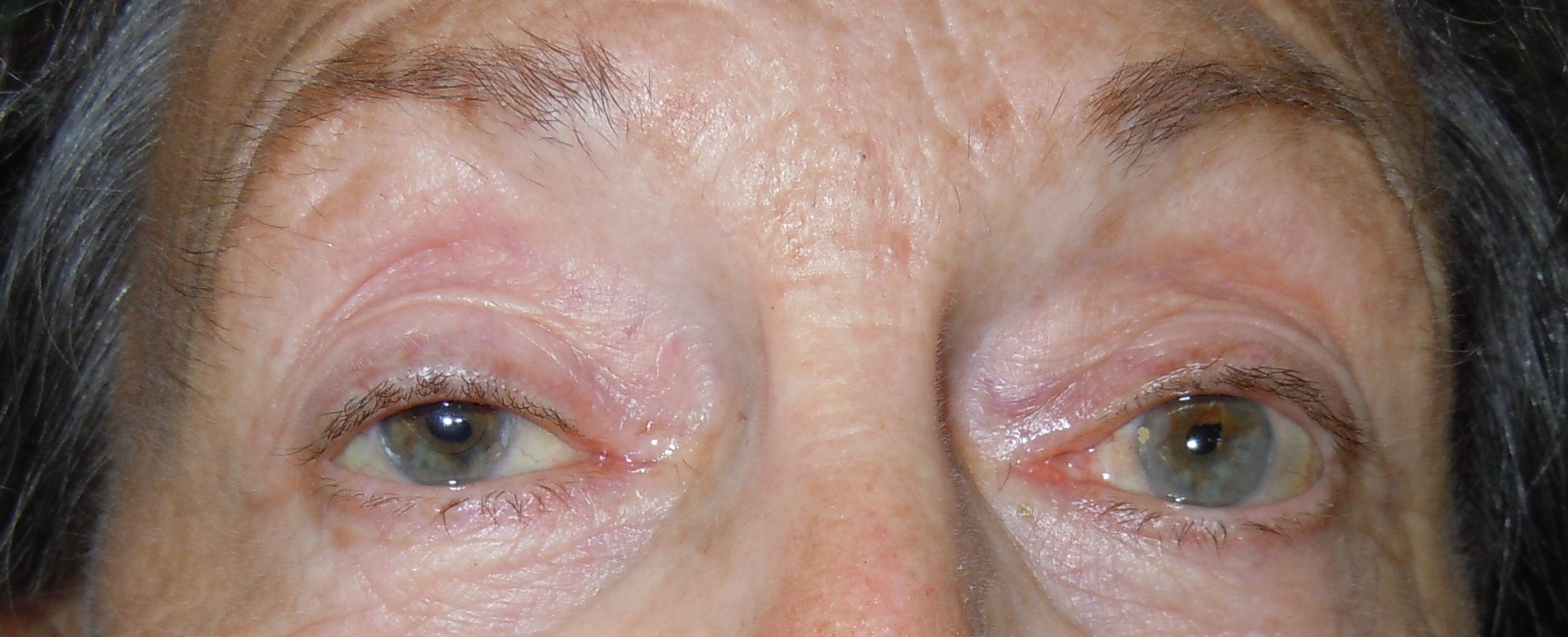 photo d'une patient avec un ptosis