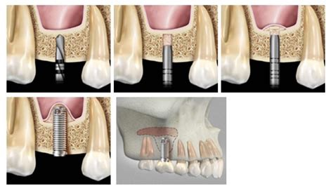 les différentes étapes du sinus lift